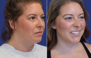 34 year-old patient before and after neck liposuction