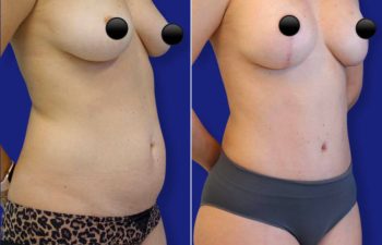 patient before and after tummy tuck