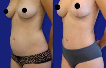 patient before and after tummy tuck