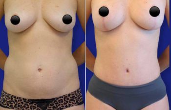 patient before and after tummy tuck