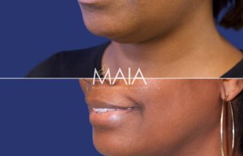 41 year-old patient before and after neck liposuction