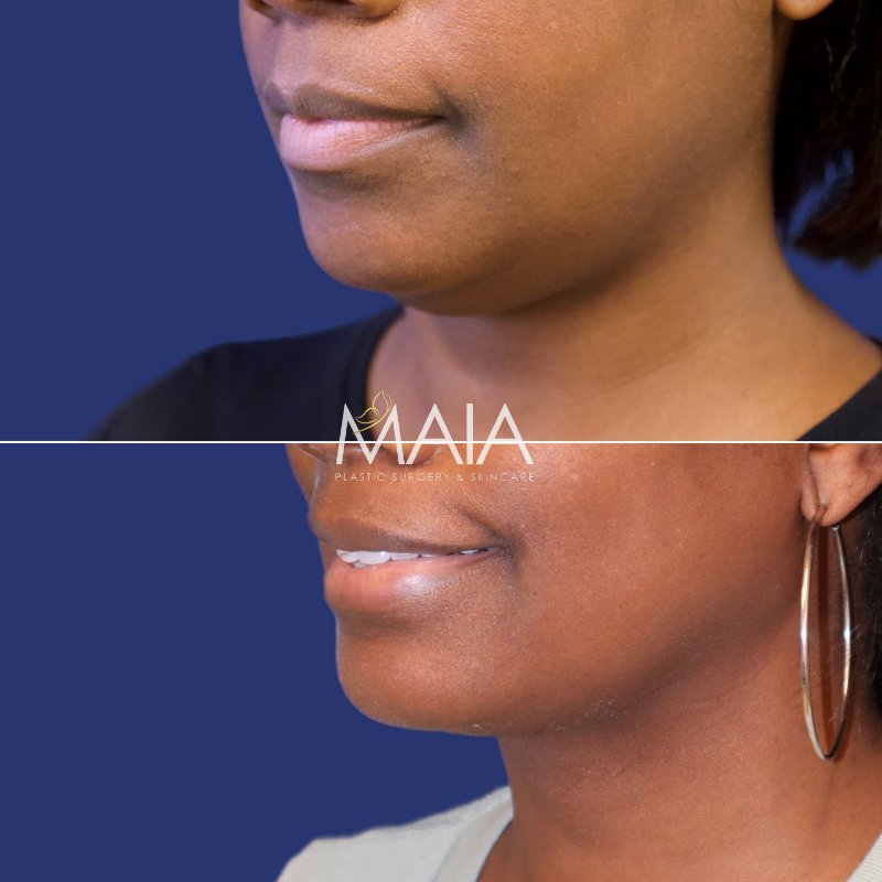 🥇 Liposuction  Maia Plastic Surgery