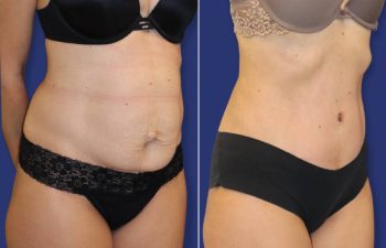 patient before and after tummy tuck