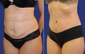 patient before and after tummy tuck