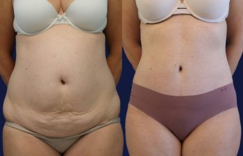 patient before and after tummy tuck