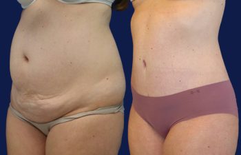 patient before and after tummy tuck