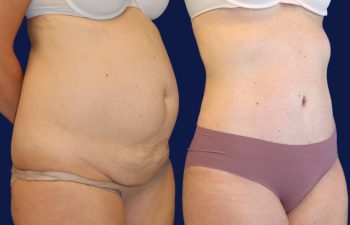 patient before and after tummy tuck