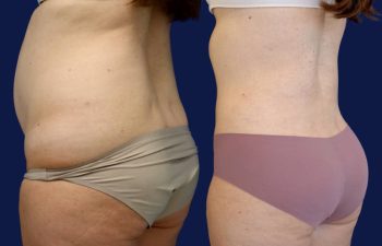 patient before and after tummy tuck