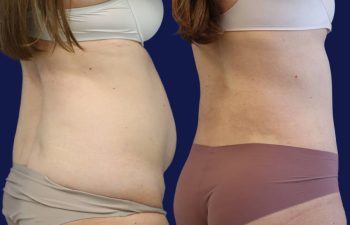 patient before and after tummy tuck