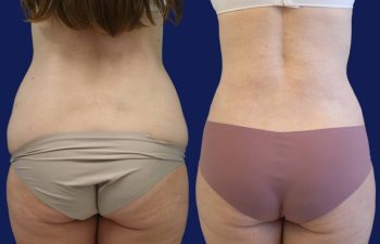 patient before and after tummy tuck