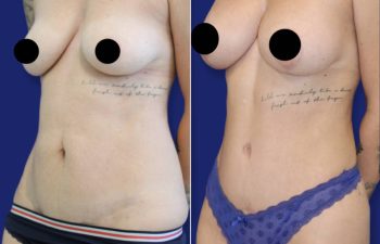 patient before and after tummy tuck