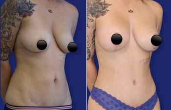 patient before and after tummy tuck