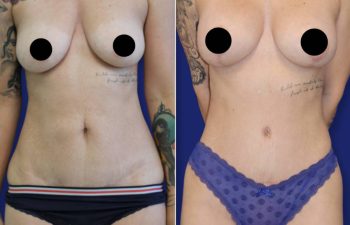 patient before and after tummy tuck