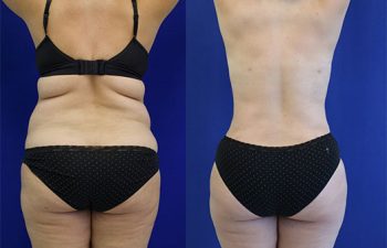 patient before and after tummy tuck
