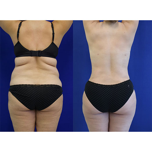 patient before and after tummy tuck