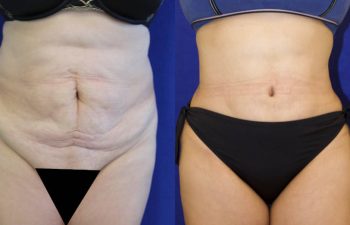 patient before and after tummy tuck