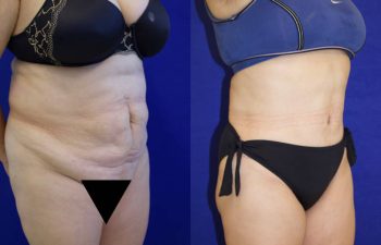 patient before and after tummy tuck