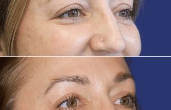 47 year-old patient before and after upper blepharoplasty