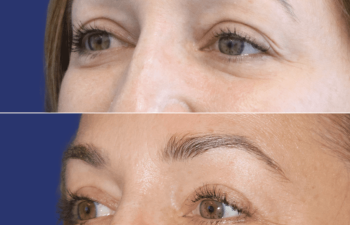 47 year-old patient before and after upper blepharoplasty