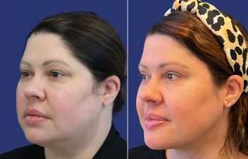 49 year old patient before and 2 weeks after neck liposuction