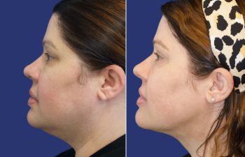 49 year old patient before and 2 weeks after neck liposuction
