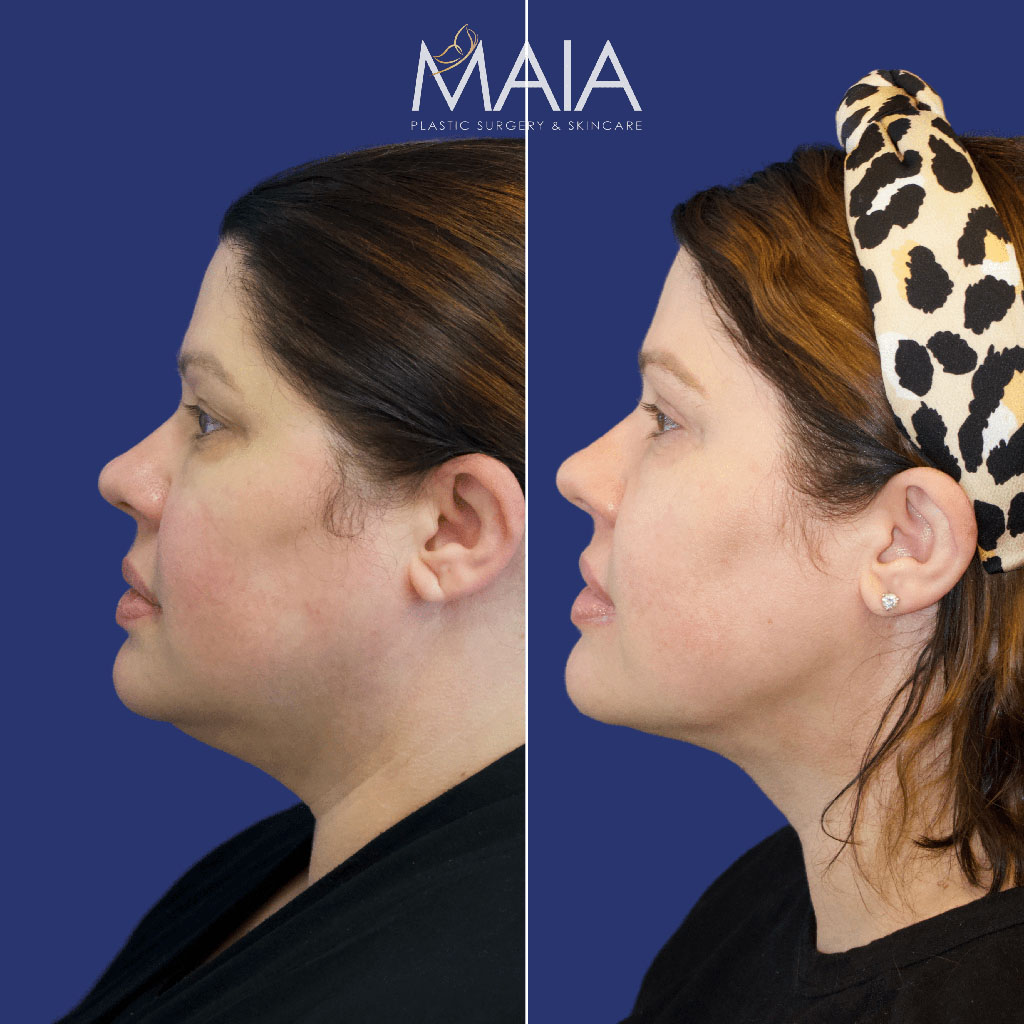 🥇 Liposuction  Maia Plastic Surgery