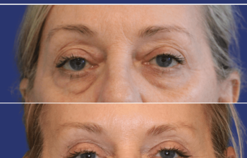 61 year-old patient before and after upper & lower blepharoplasty, brow lift, facial fat grafting, and TCA peel