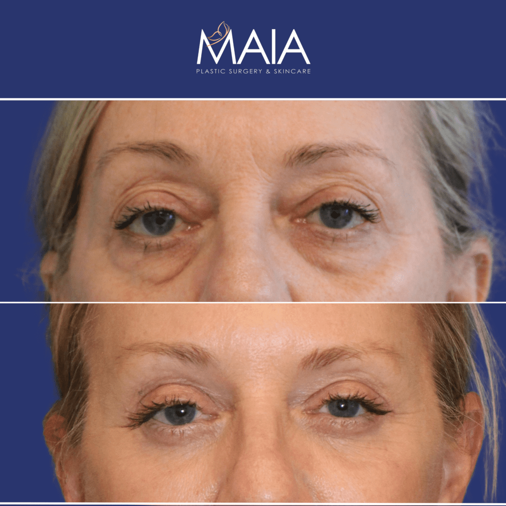 Lower Blepharoplasty Before & After Photos