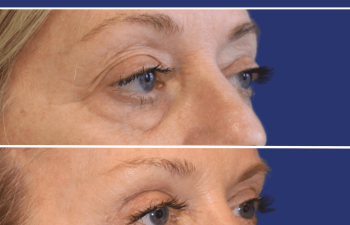 61 year-old patient before and after upper & lower blepharoplasty, brow lift, facial fat grafting, and TCA peel