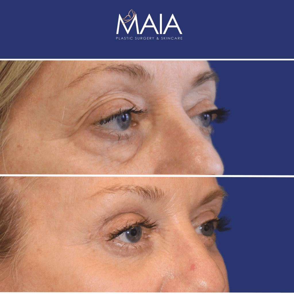 61 year-old patient before and after upper & lower blepharoplasty, brow lift, facial fat grafting, and TCA peel