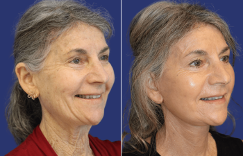 65 year-old patient before and 6 weeks after face and neck lift