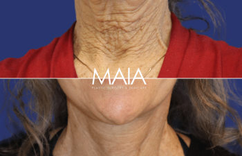 65 year-old patient before and 6 weeks after face and neck lift