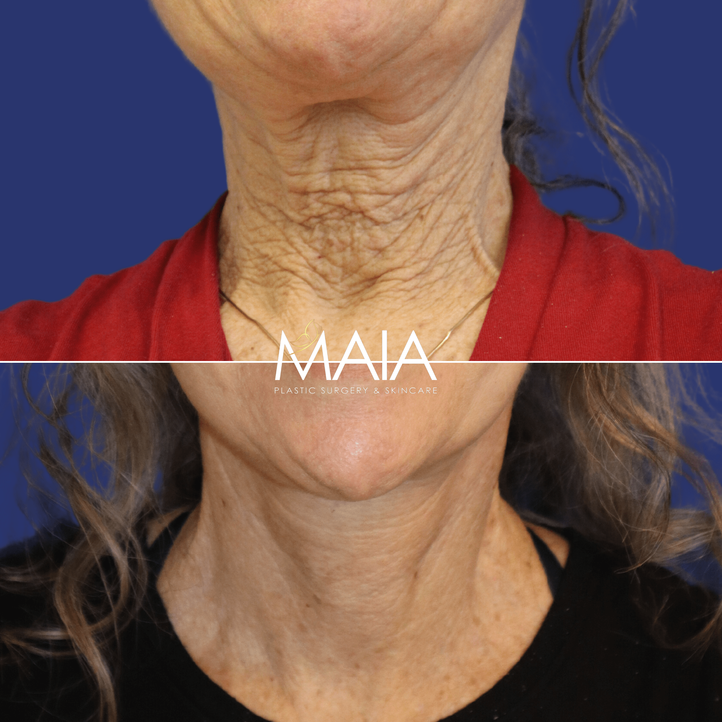 65 year-old patient before and 6 weeks after face and neck lift