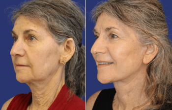 65 year-old patient before and 6 weeks after face and neck lift