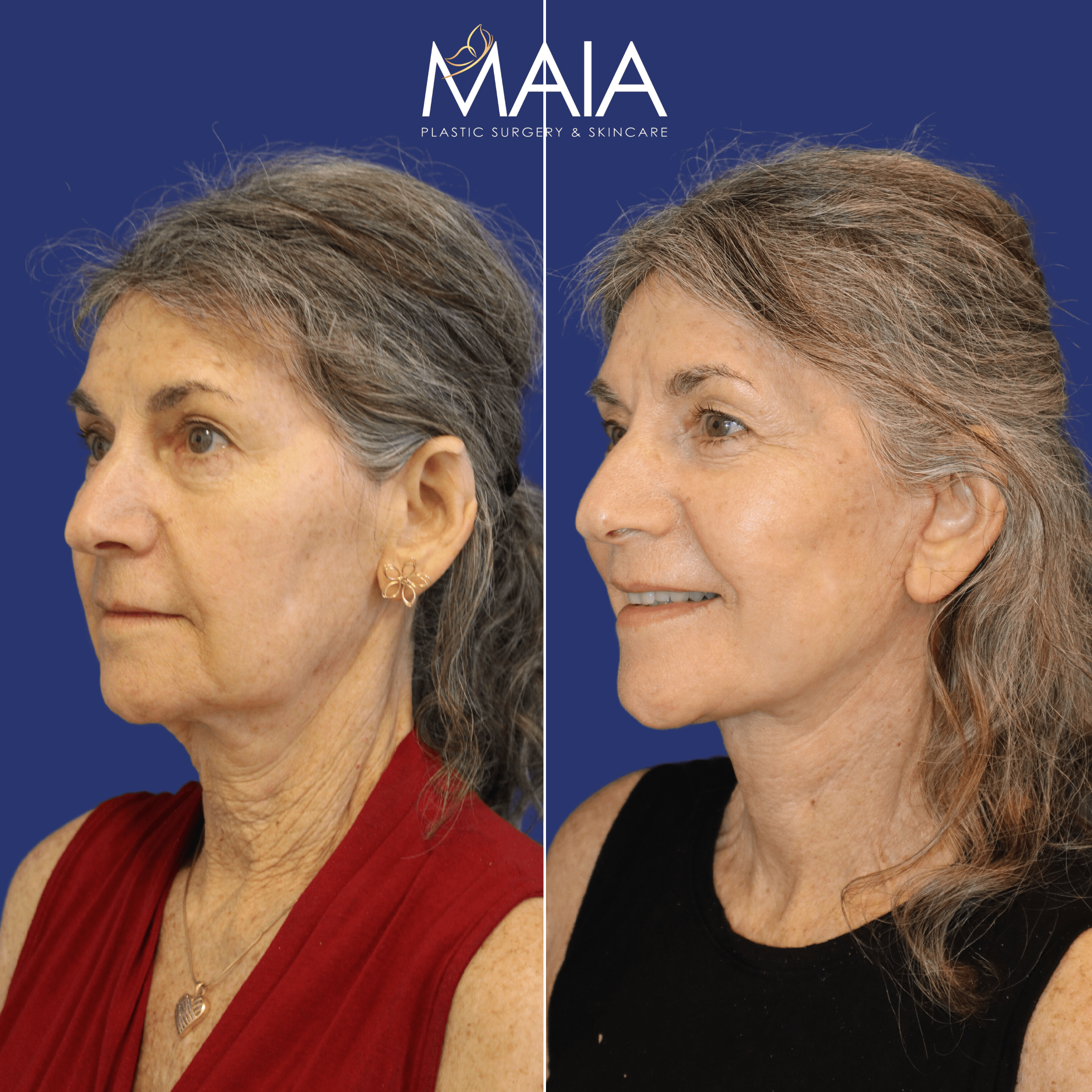 65 year-old patient before and 6 weeks after face and neck lift