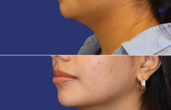 22 year old patient before and after neck liposuction
