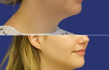 27 year-old patient before and after neck liposuction