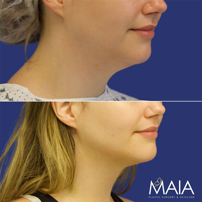 🥇 Liposuction  Maia Plastic Surgery