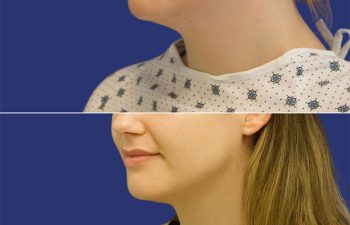 27 year-old patient before and after neck liposuction