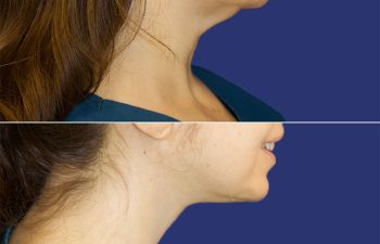 43 year-old patient before and after neck lift