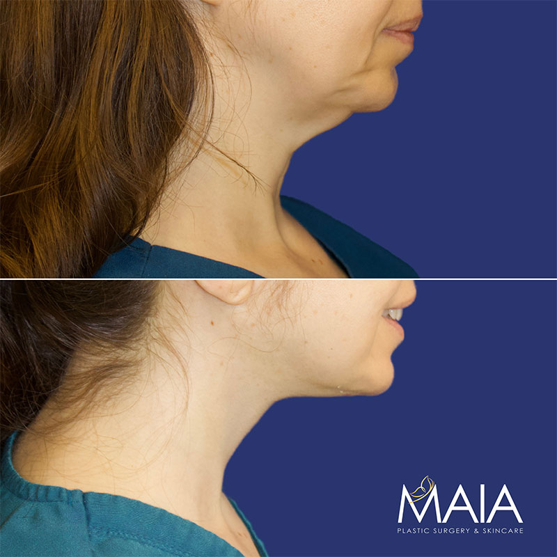 43 year-old patient before and after neck lift