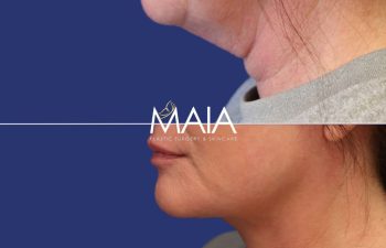 49 year-old patient before and 2.5 months after facelift, neck lift, upper blepharoplasty, and TCA peel