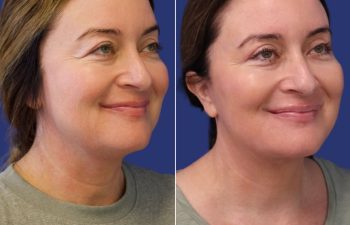 49 year-old patient before and 2.5 months after facelift, neck lift, upper blepharoplasty, and TCA peel