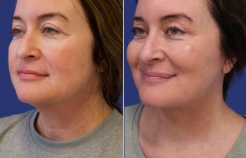 49 year-old patient before and 2.5 months after facelift, neck lift, upper blepharoplasty, and TCA peel