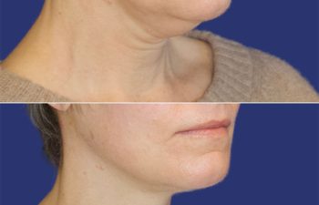 49 year-old before and after Facelift, Necklift, Lower Blepharoplasty, Fat Grafting to Face