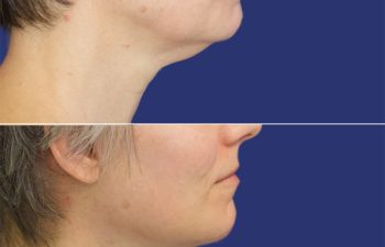 50 year-old before and after Facelift, Necklift, Lower Blepharoplasty, Fat Grafting to Face