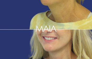 57 year-old patient before and after Facelift, Neck Lift, Upper and Lower Bleph, Brow Lift, Fat Grafting, TCA peel