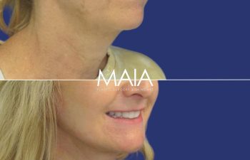 57 year-old patient before and after Facelift, Neck Lift, Upper and Lower Bleph, Brow Lift, Fat Grafting, TCA peel
