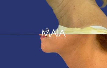 57 year-old patient before and after Facelift, Neck Lift, Upper and Lower Bleph, Brow Lift, Fat Grafting, TCA peel
