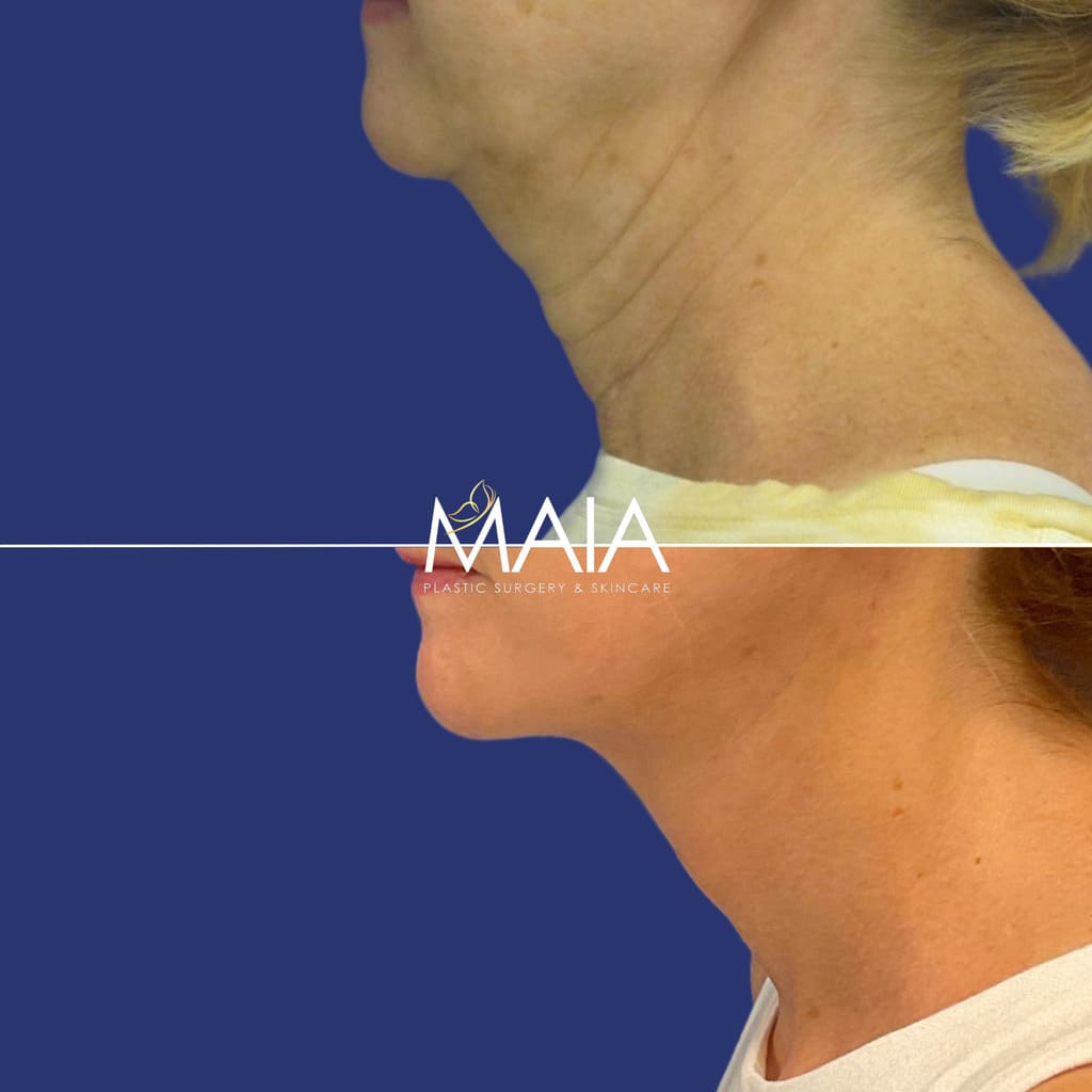57 year-old patient before and after Facelift, Neck Lift, Upper and Lower Bleph, Brow Lift, Fat Grafting, TCA peel